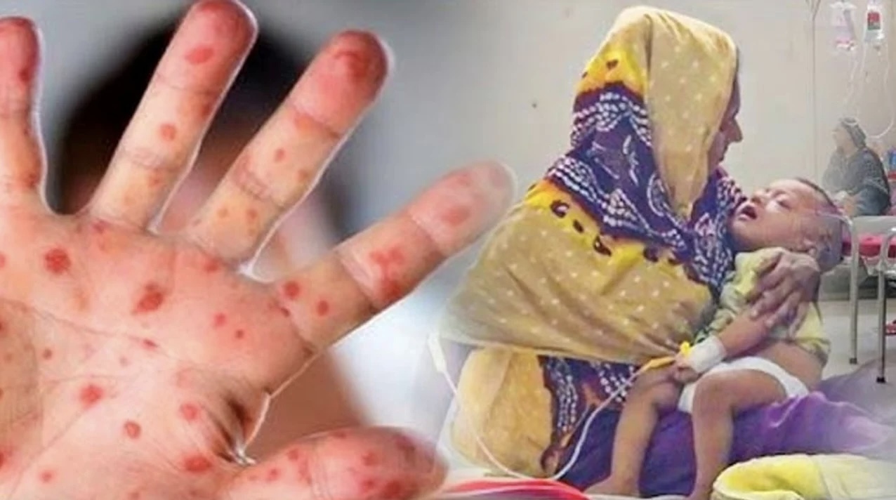 শিশুর হাম হলে তালিকা থেকে বাদ দেবেন যেসব খাবার 14940_IMG_9344.jpeg